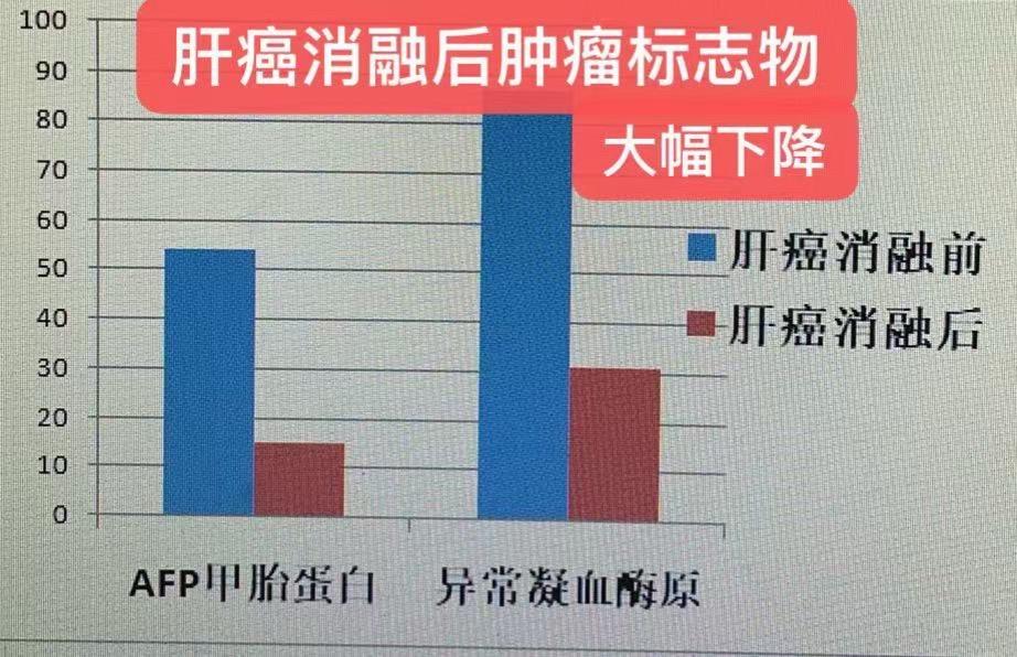多发肝癌的超声消融治疗。多发肝癌，难以手术彻底切除，身体也难以耐受手术...