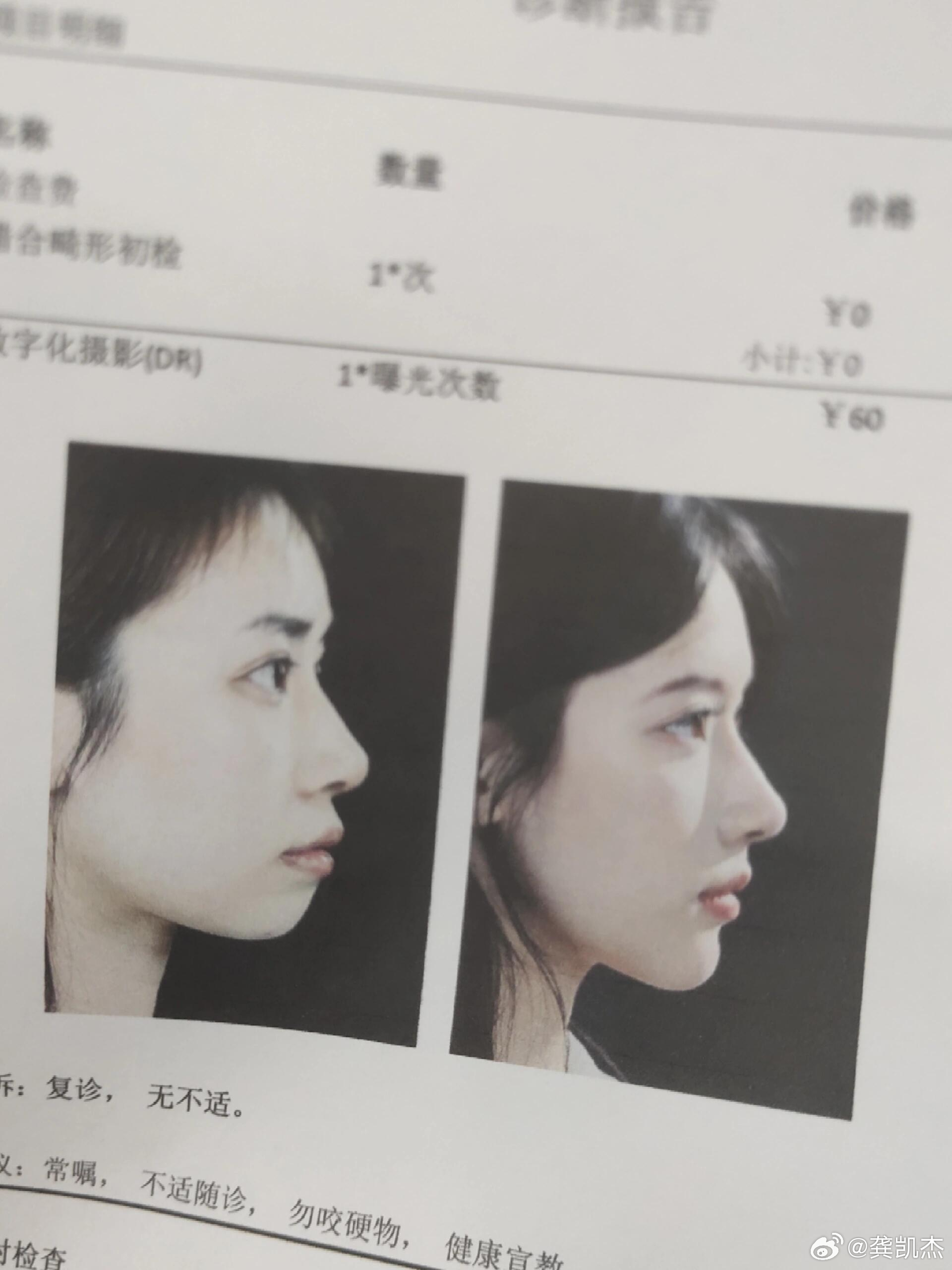 美女整牙前后对比，你们觉得变化大么 ​​​