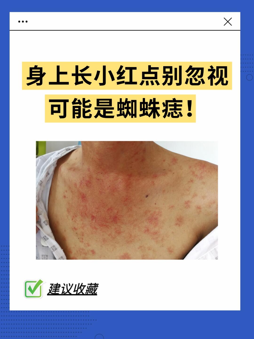 身上长小红点别忽视，可能是蜘蛛痣！