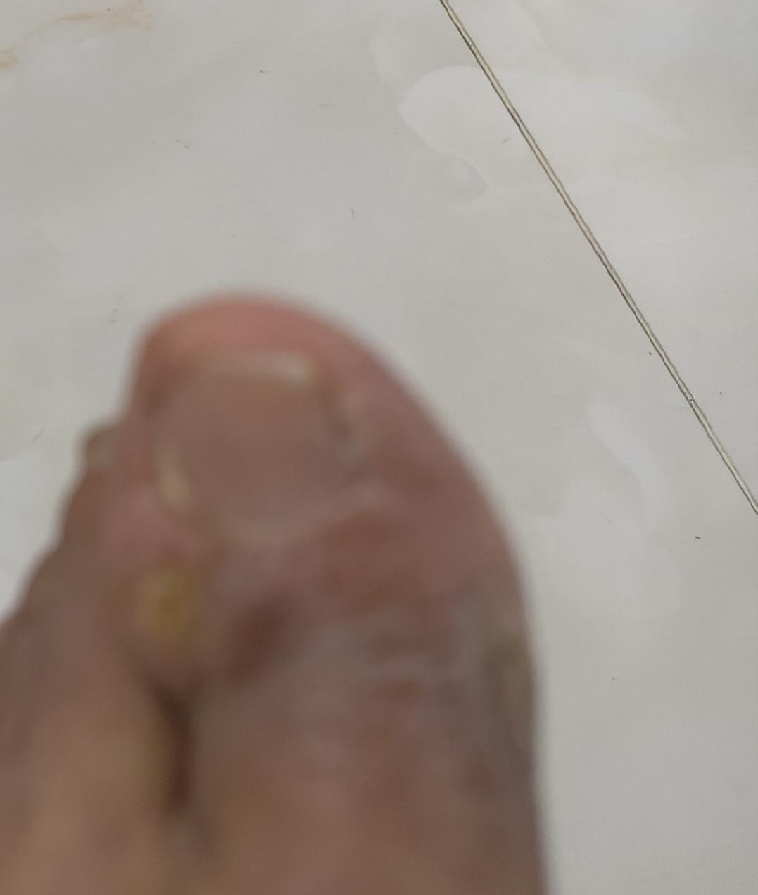 我左脚大拇指左侧长了一个疙瘩，发病至今差不多有十年了，起先只有黄豆般大，不痛，不