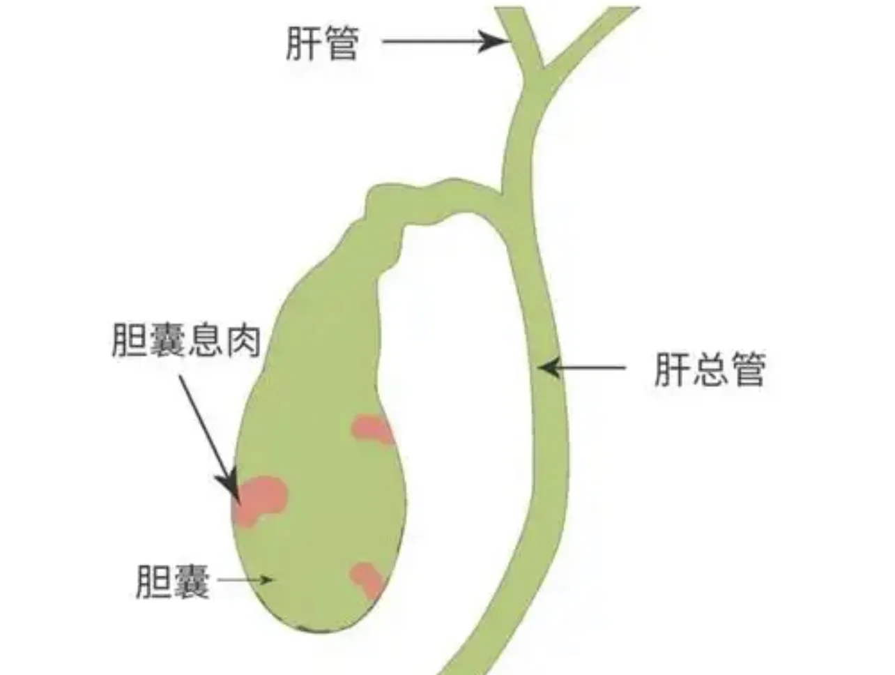 胆囊息肉会自己消失不见吗？！