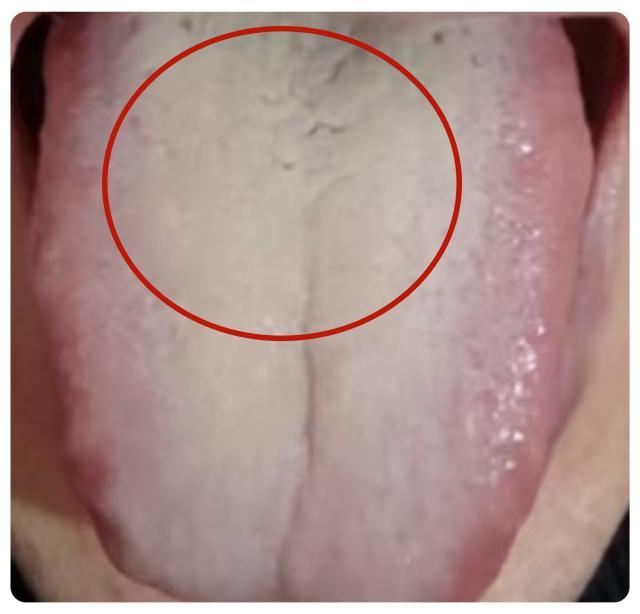 痰湿淤血结伴而行，一个中成药，统统说拜拜！
中医上说呀，痰湿和淤血那可是互为因果