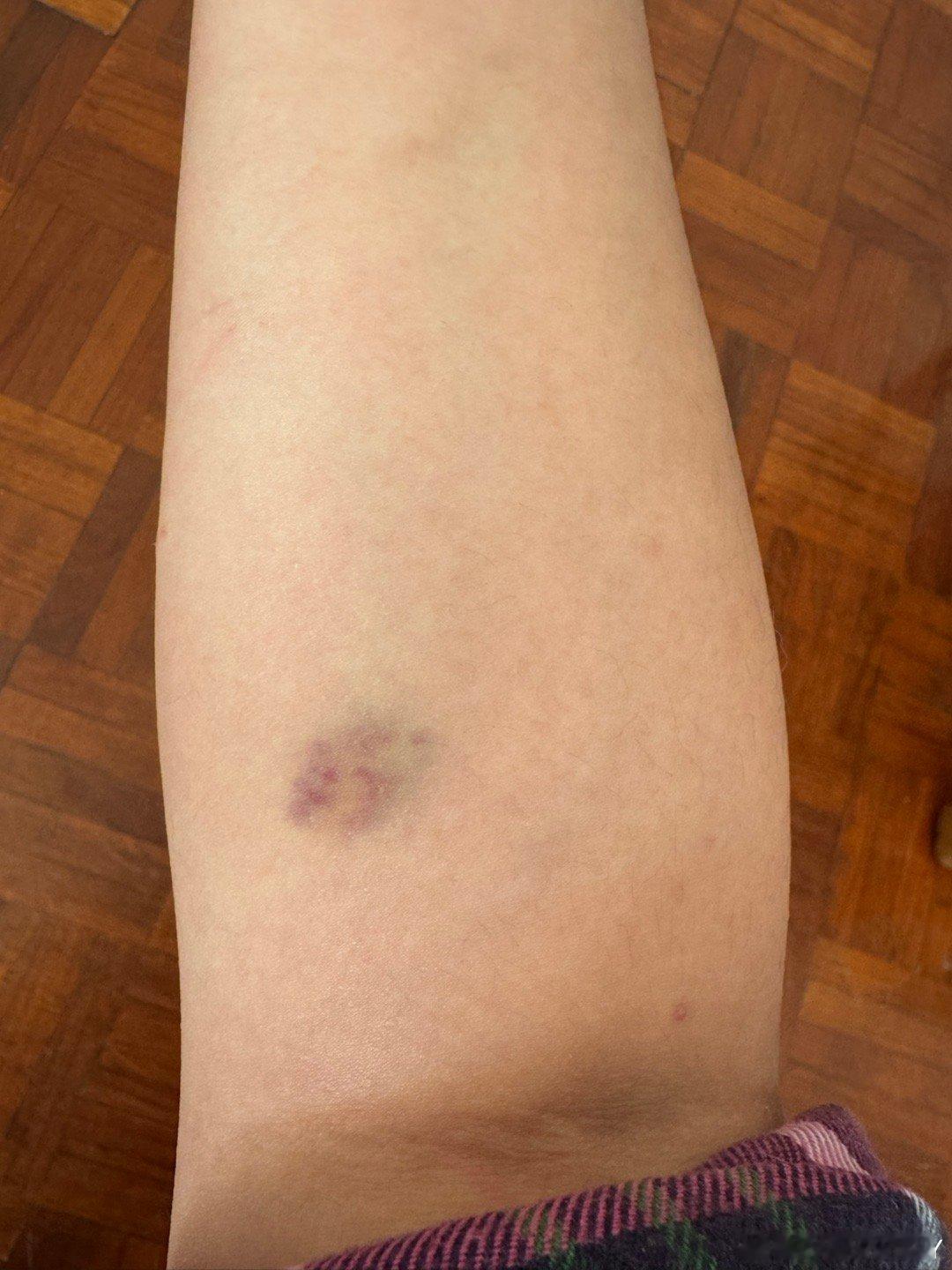 咪的天 我儿这是练过武术啊这给我蹬的 都青了一块