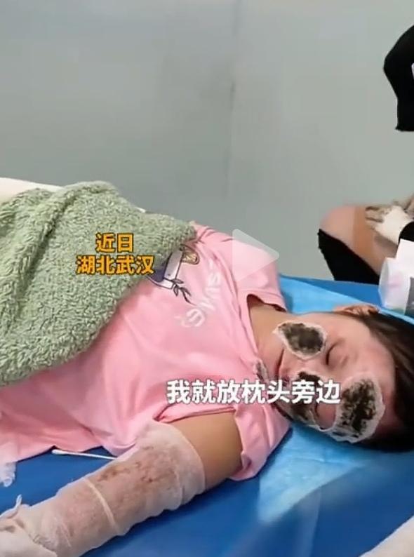 整夜充电手机爆炸
主人面部烧伤严重

近日来自湖北武汉的消息让人揪心又震惊。
