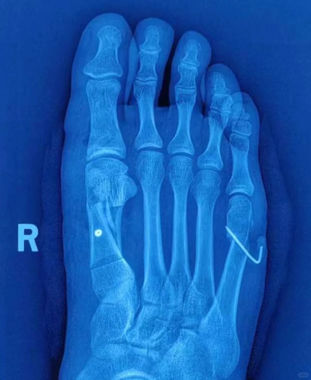 拇趾畸形是拇外翻，小趾呢？