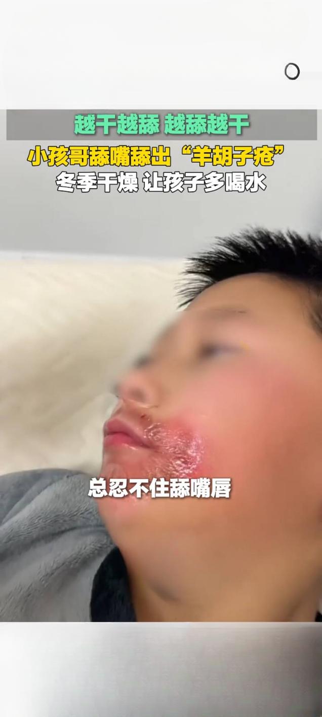 越干越舔！安徽10岁男孩舔唇舔出“羊胡子疮”，医生支招破解恶性循环
 
2026