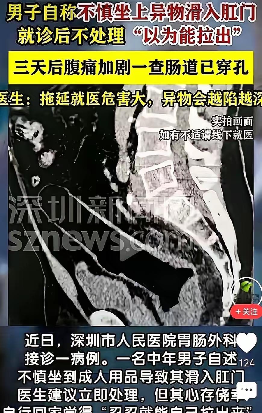 直到我看到深圳大叔不不慎摔了一跤，这成人用品滑进了肛门，我瞬间无语了。
成人物品