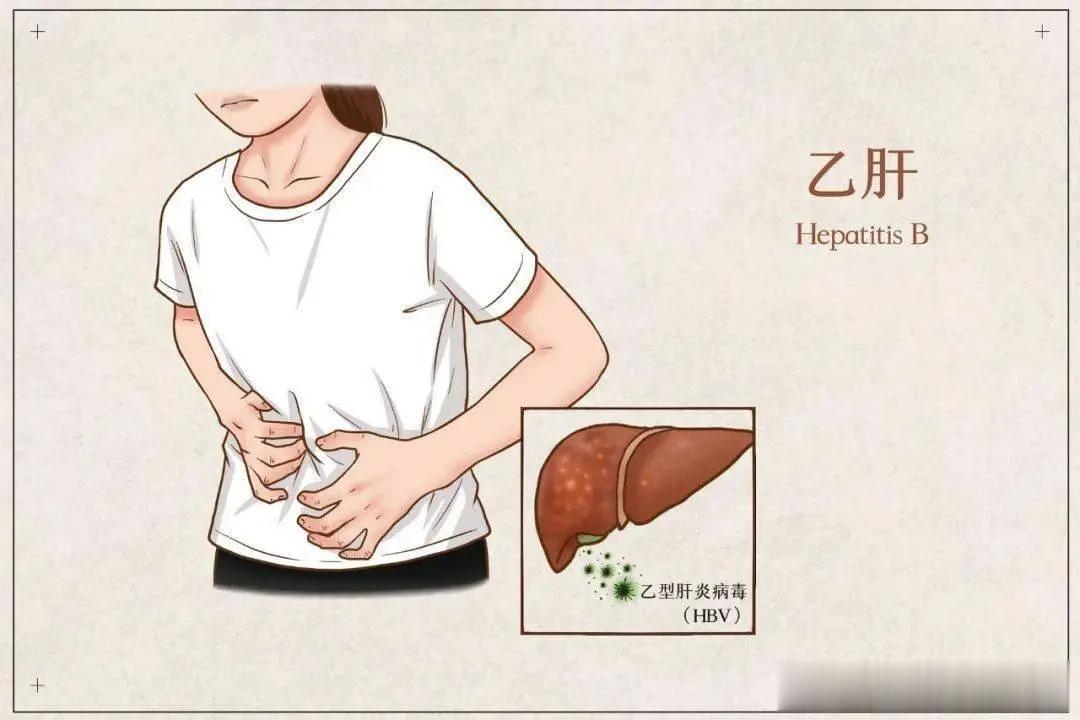 乙肝患者治疗的5大误区，你也有吗？1. 没有症状表现就不用治疗大多数早期肝炎都没