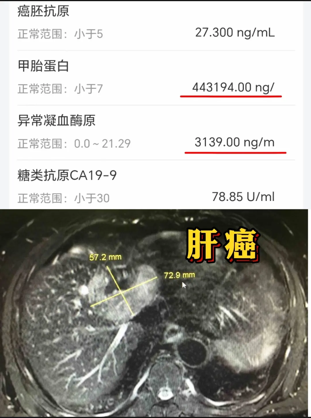 第9例！乙肝小三阳不重视发展为肝癌。这张检查单是我这一周以来见过的最严...