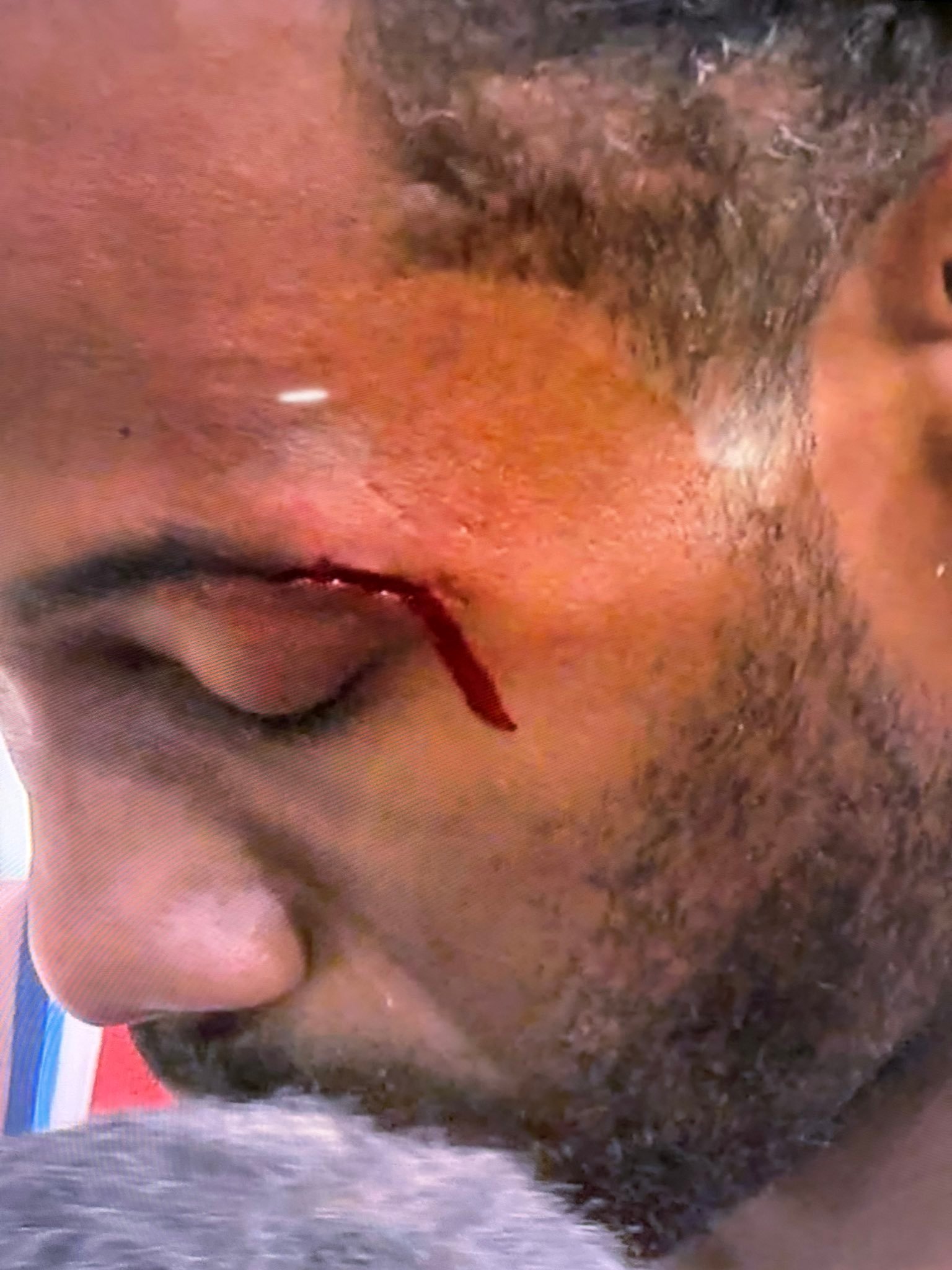 被开眼角了…紧急下场处理下伤口 