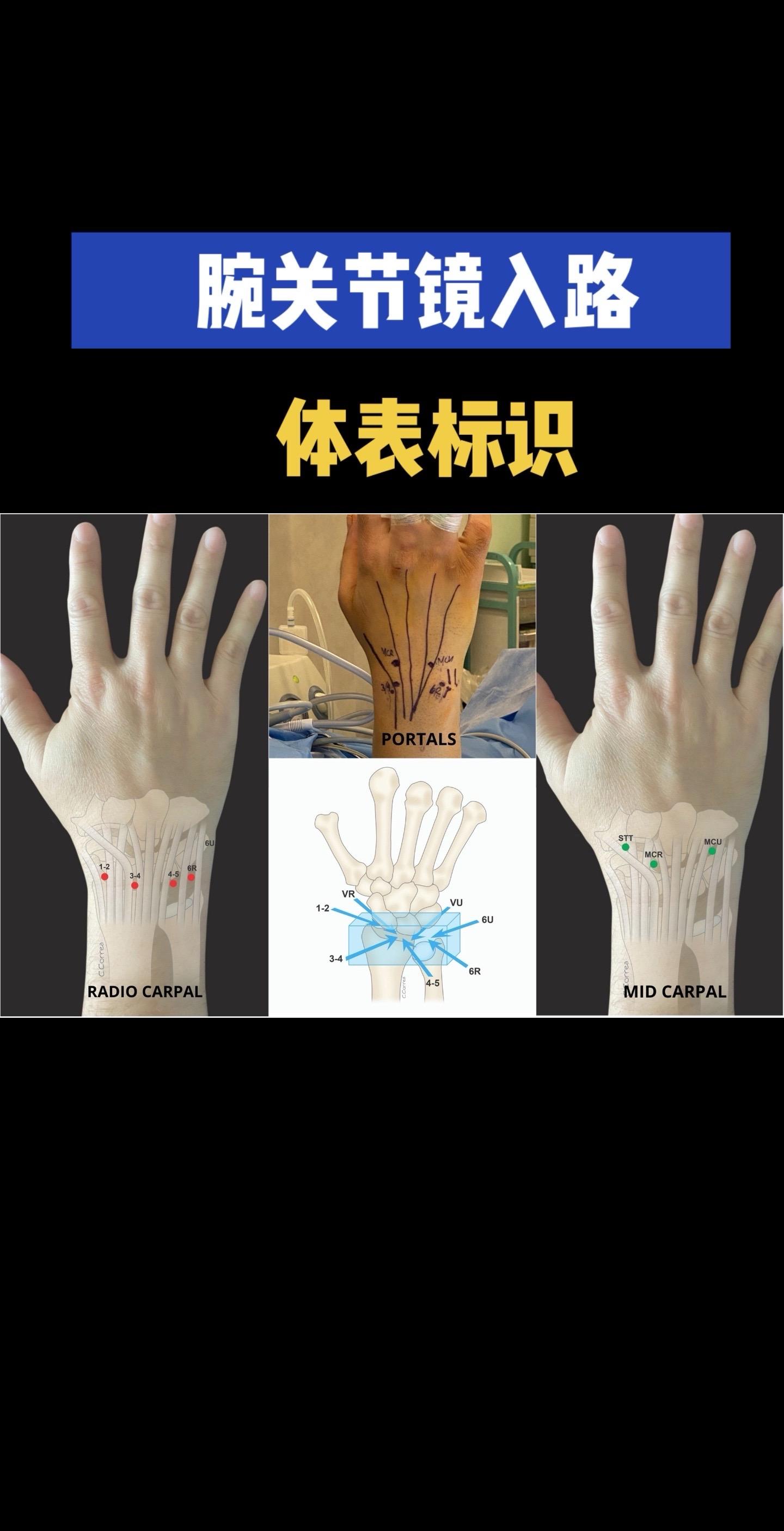 腕关节镜标准入路+体表标记。手腕里的‘高速公路’地图！关节镜从哪进？肌...