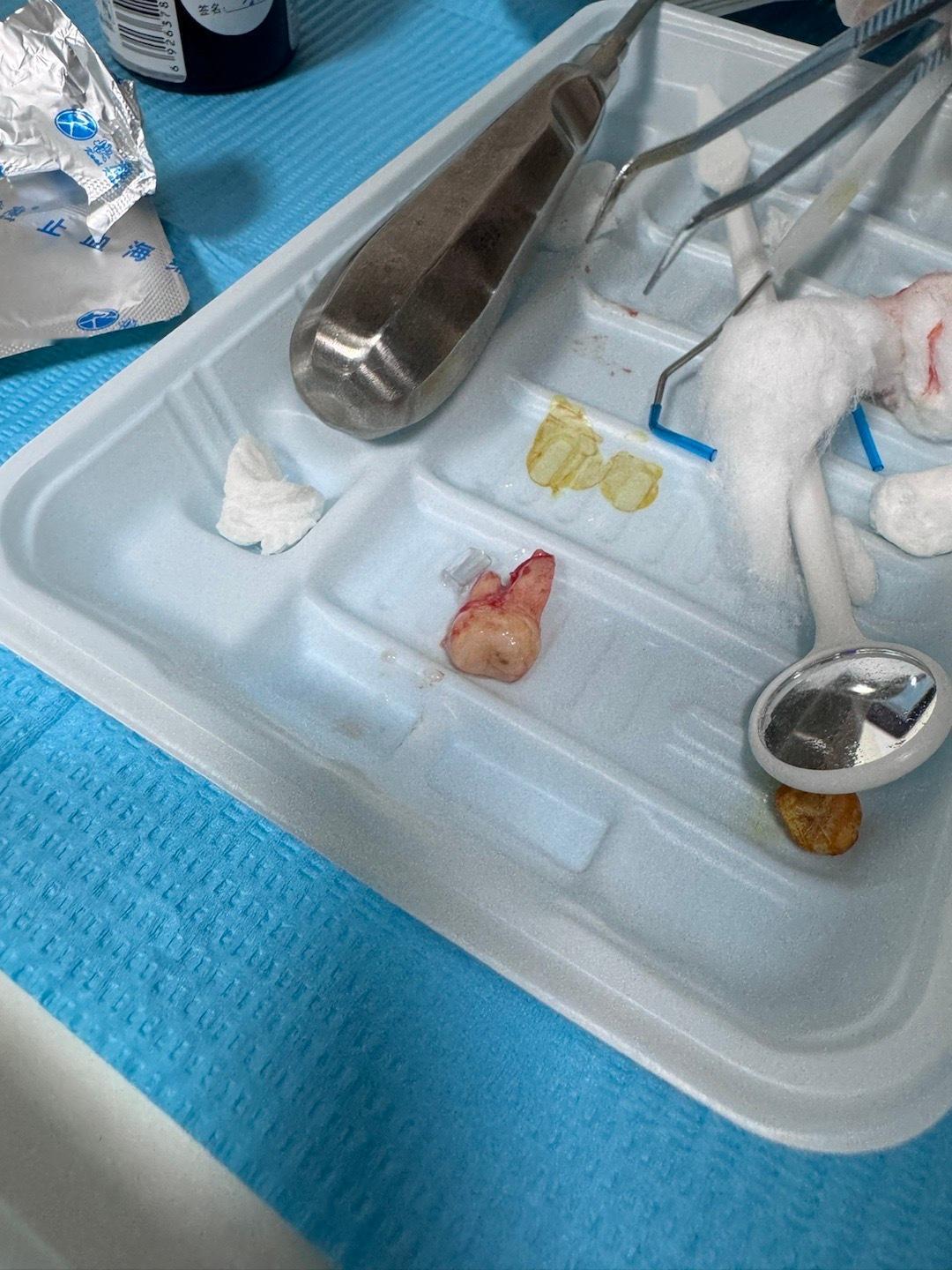 绝了 几秒钟就拔了 没有任何感觉[傻眼] ​​​