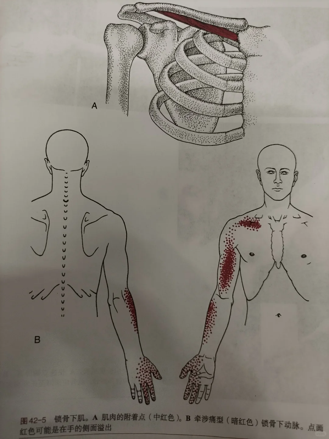 胸大肌触发点的激活和持续