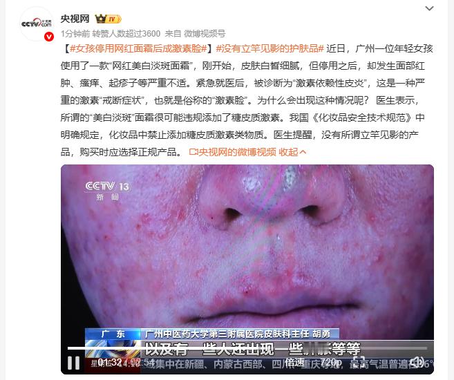 女孩停用网红面霜后成激素脸 广州女孩跟风入手网红美白淡斑面霜，刚上脸的那段时间皮
