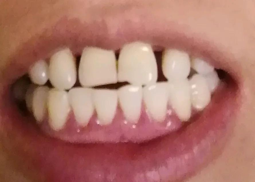 之前有网友提醒我去做牙龈刮治，搜了一下，有人说治疗时疼痛难忍，治疗后牙齿敏感、牙