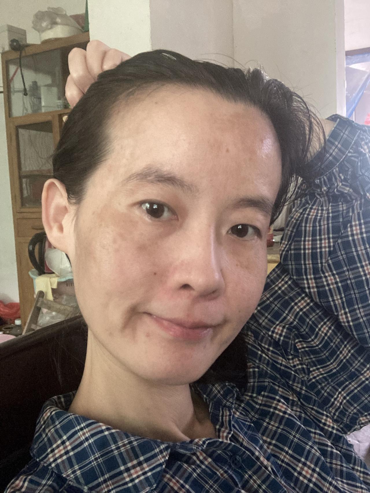 洗的最干净的一次脸了，斑越来越严重。有人要问，为什么不去治？关注我久的人才知道。