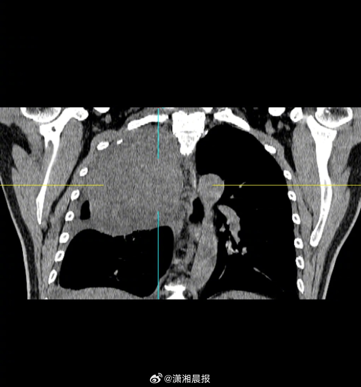 【52岁#男子咳嗽老不好肺部查出16cm肿瘤#】近日，郴州市第一人民医院东院胸部