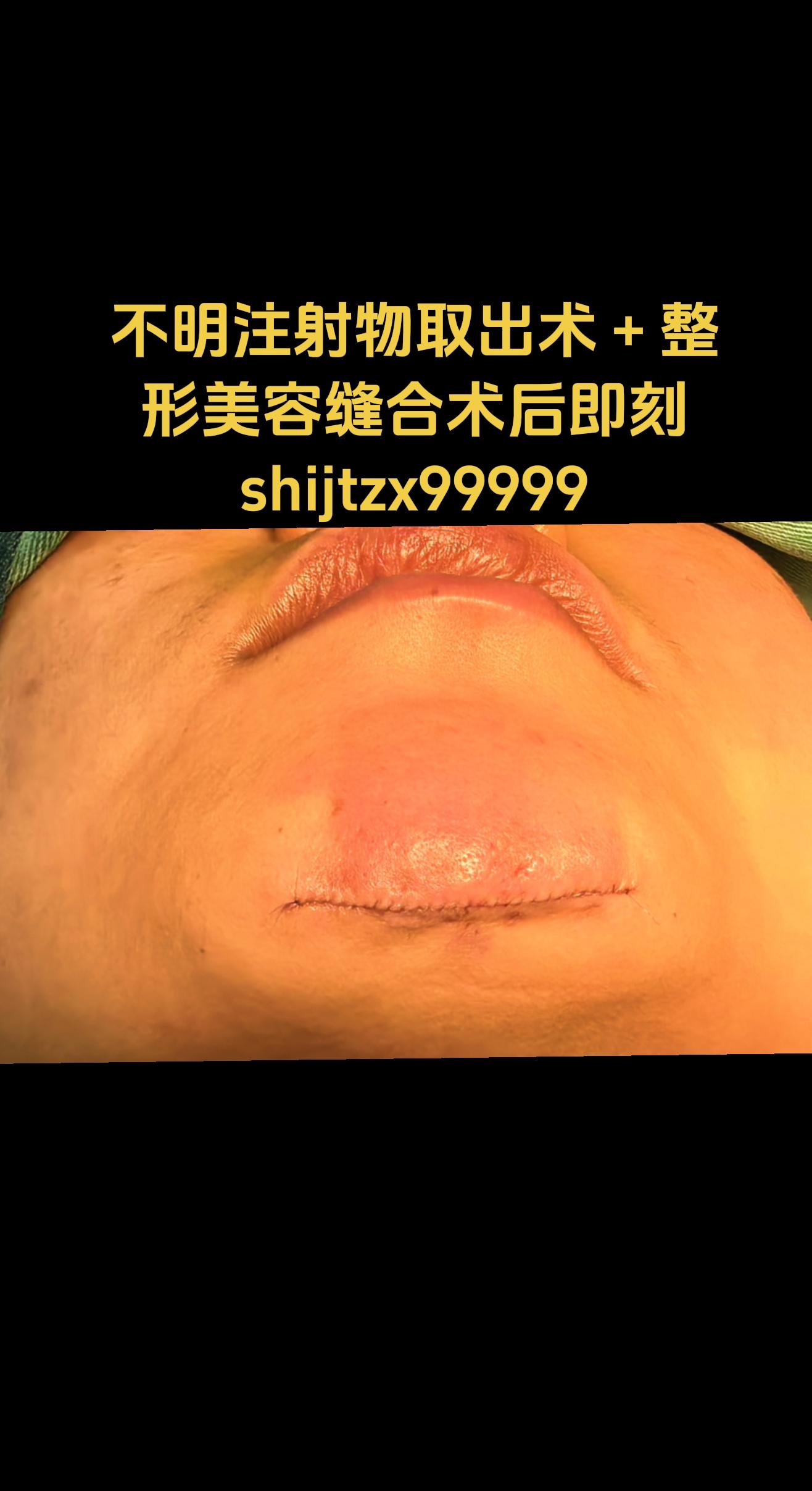 不明注射物。自述3年前注射bns填充下巴，1年后发现下巴变形变尖，溶解...