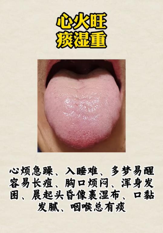 失眠犯困、下身潮湿、上热下寒，4 种舌象看懂体内火、湿、虚