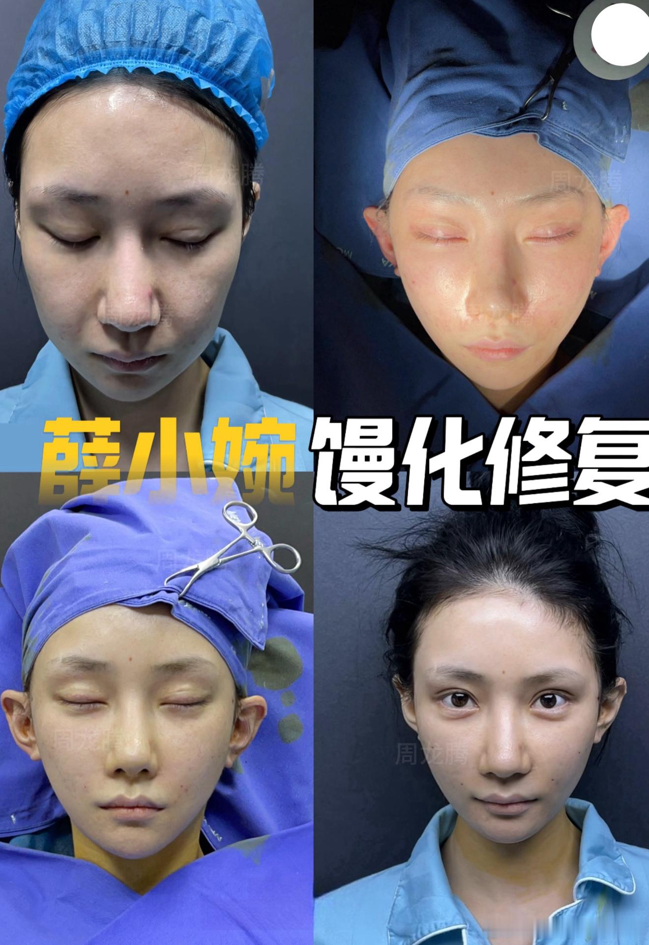任权被整容后的薛小婉吓到了又双叒整容了！额头、眉眼、发际线全安排上。术后那状态，