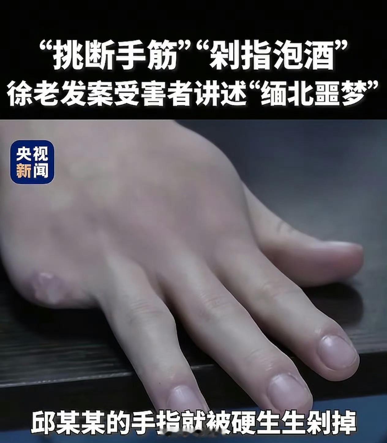 缅北电诈园区剁人手指泡酒卧槽！真特么残忍，毫无人性！ ​​​