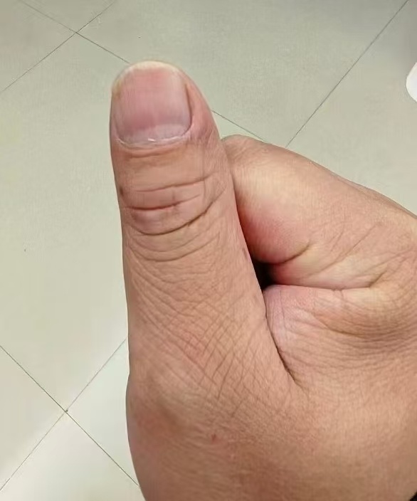 案例反馈：图一为白癜风，图二用了密陀僧散涂醋+隔蒜灸治疗好的，效果显著。密陀僧散