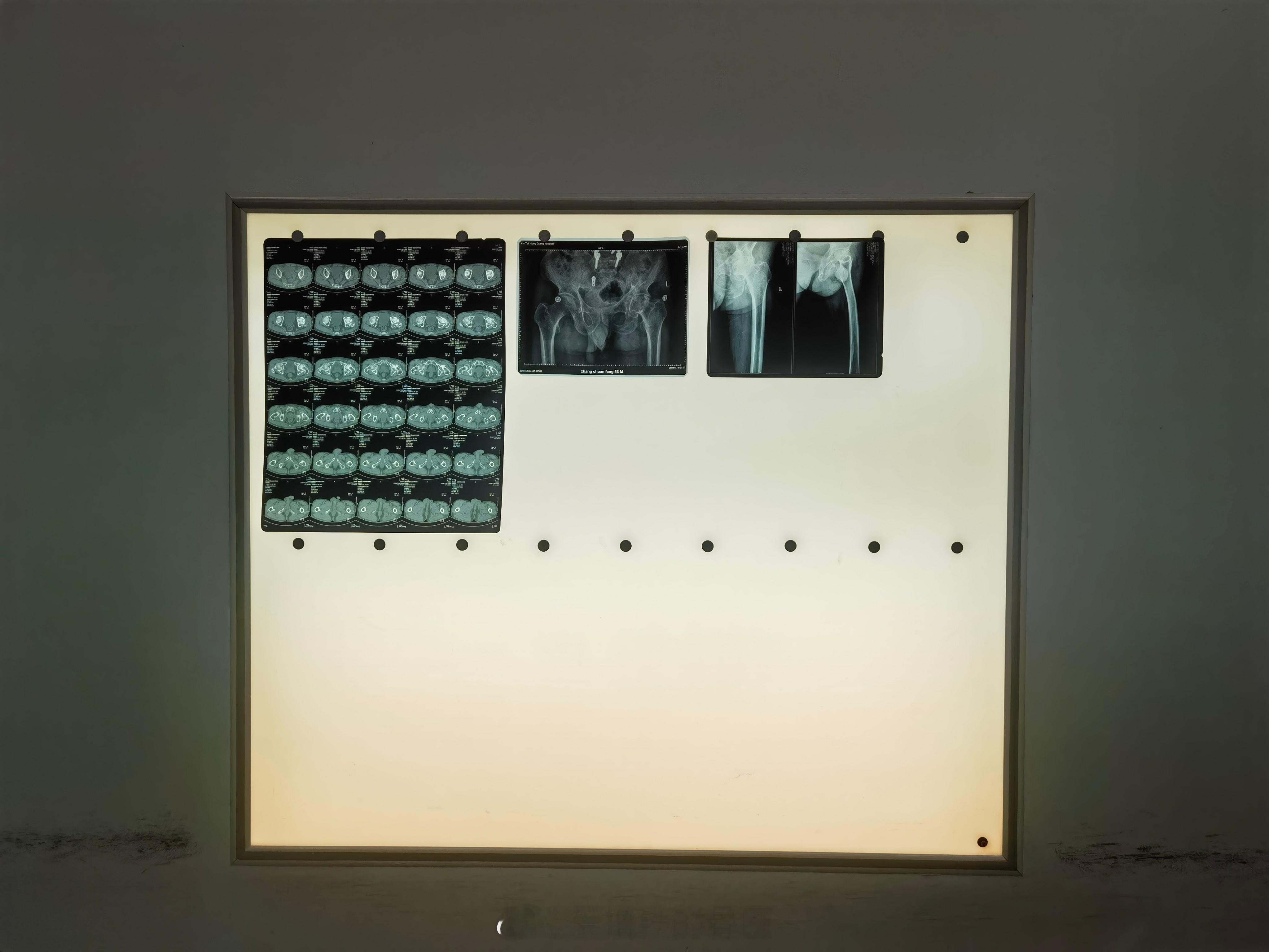 脊柱的兄弟给老张做的腰椎，术后一年，今天又来做股骨头坏死，SUPERPATH微创