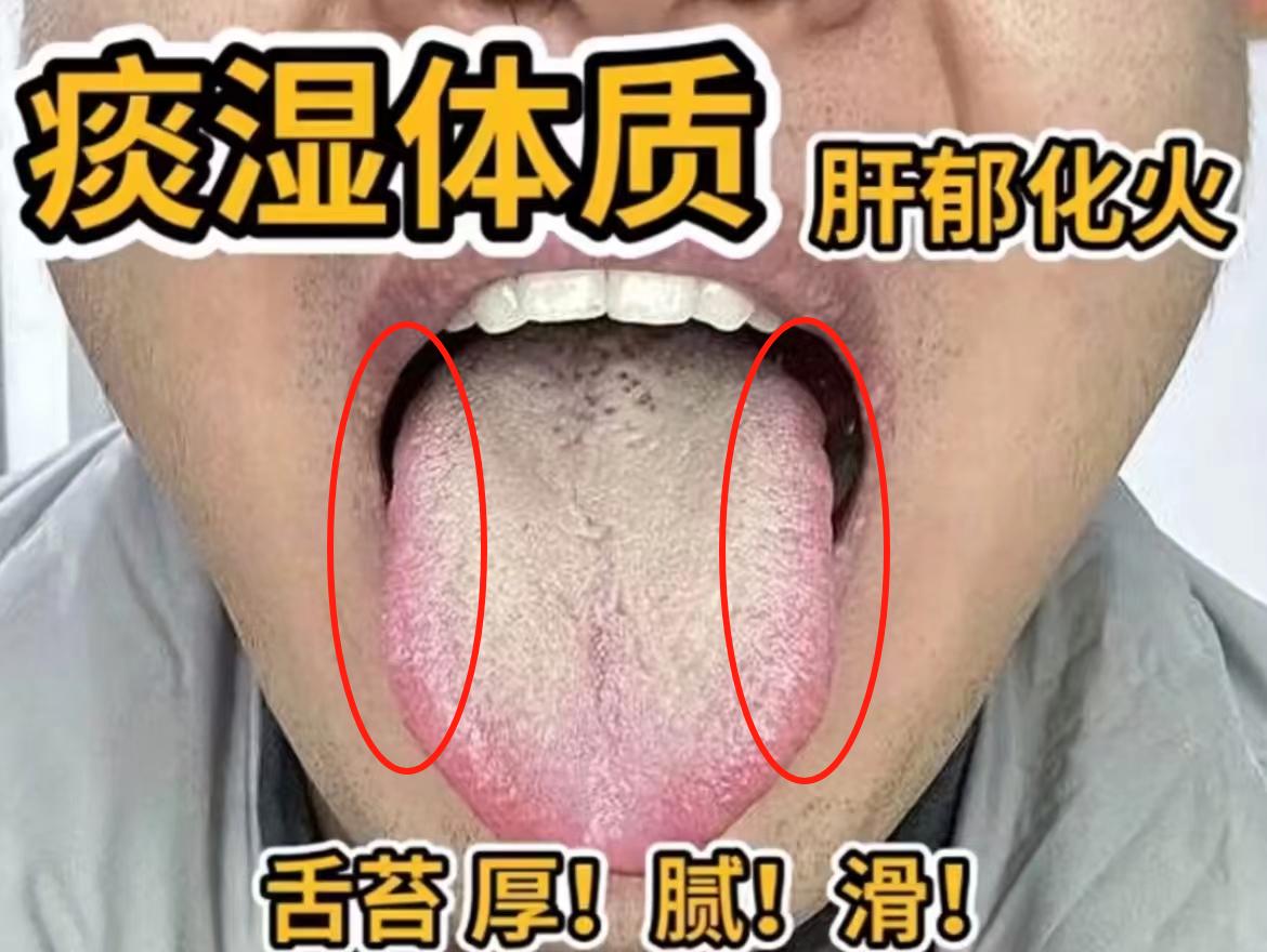 肝郁化火是什么样的舌头[思考][思考]今天潘医生带你好好认识一下[无辜笑][无辜