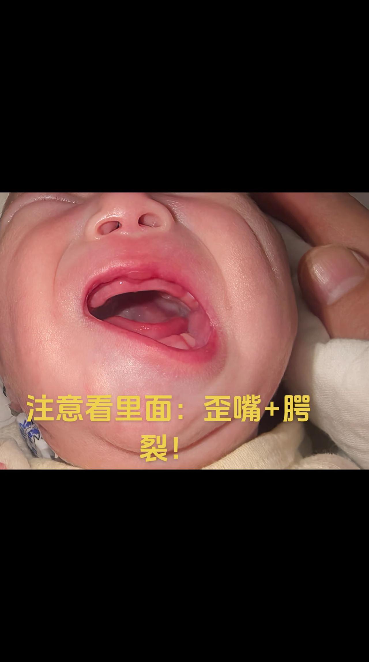 典型的歪嘴哭综合症包括心脏发育问题，外耳道发育畸形，腭裂……#歪嘴哭综合症 #宝