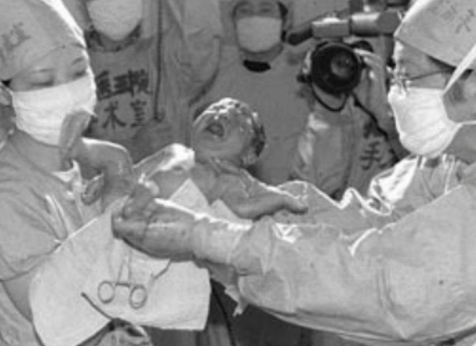 著名专家预言：试管婴儿寿命仅40年，那首例试管婴儿如今怎样了？
“试管婴儿活不过