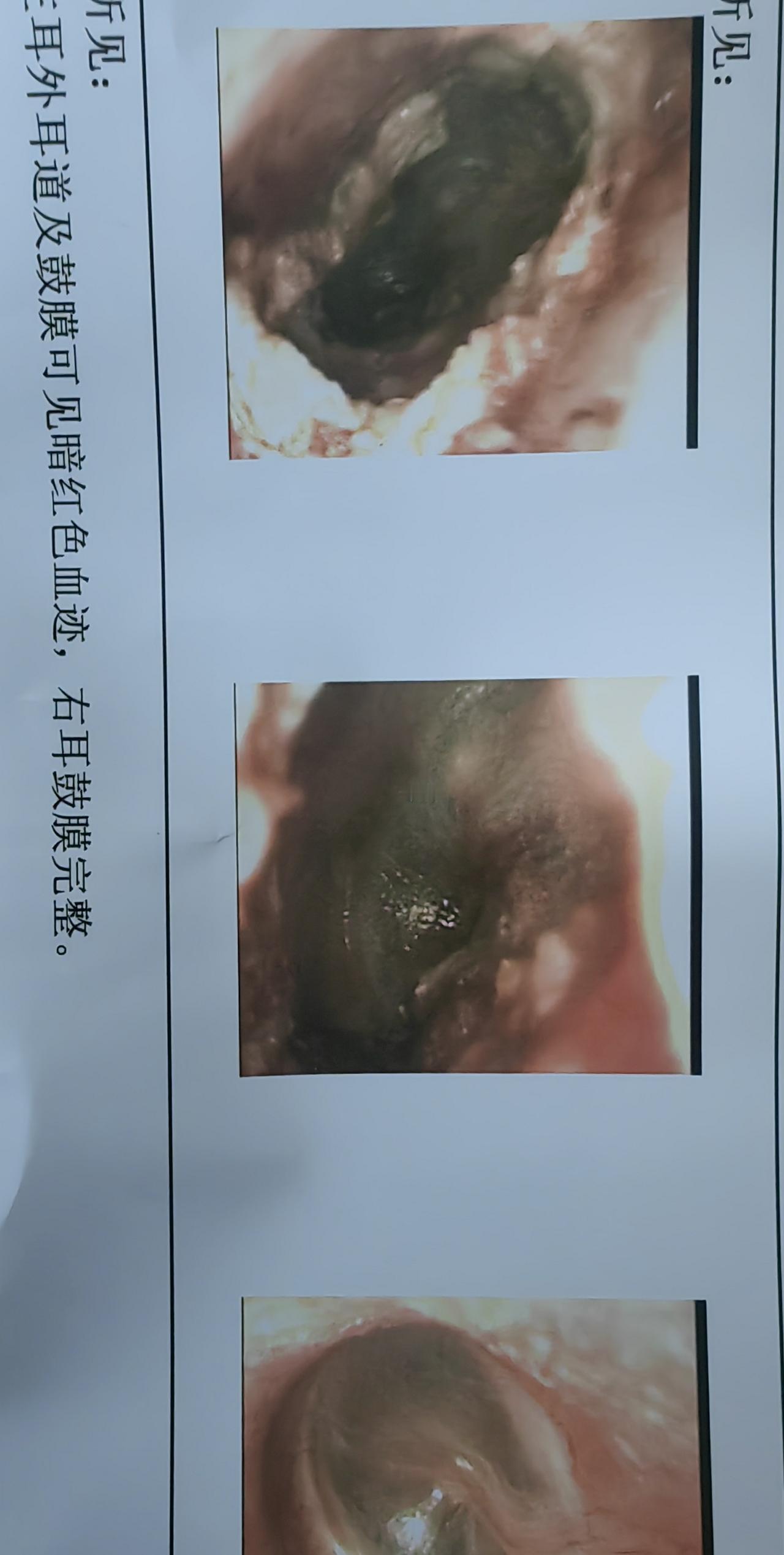 前天耳朵发生意外，里面出血了，怕是伤到耳膜，到医院挂号，普通号，15元，内镜室拍