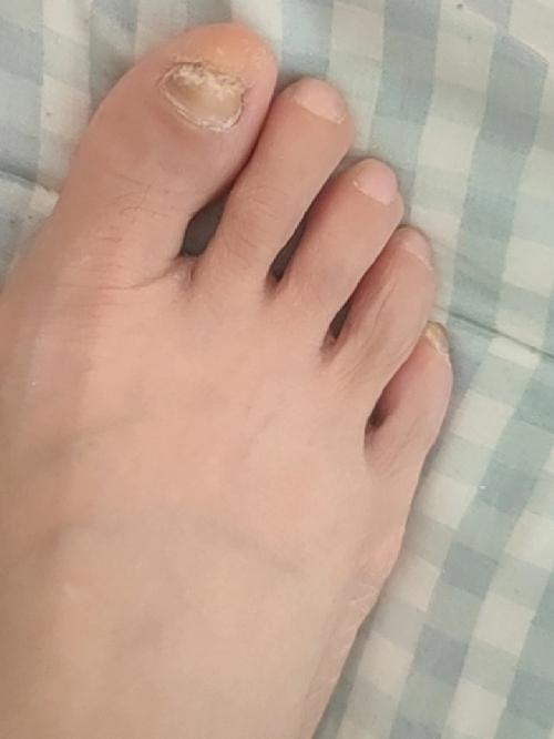 糖尿病真的折磨人，我现在不仅血糖高，而且还出现并发症了，最近我的脚底板和脚面都有