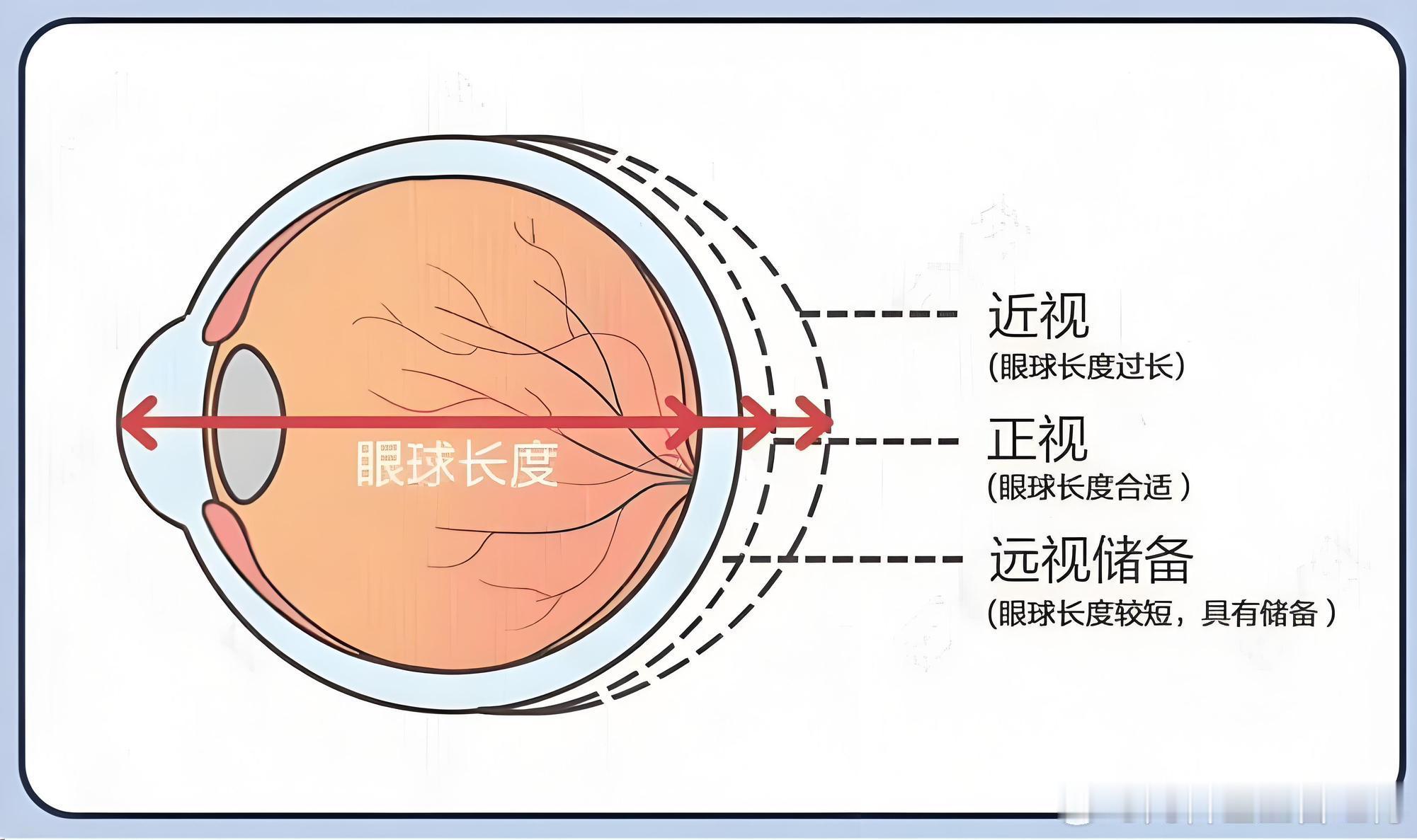 很多家长带孩子做视力检查，会听到远视储备这个词，它是孩子眼睛自带的“抗近视缓冲”