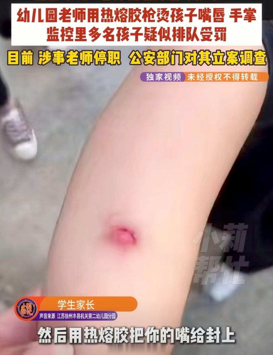多名幼儿园小朋友被老师用热熔胶烫伤江苏丰县多名幼儿园小朋友被老师用热熔胶烫伤，事