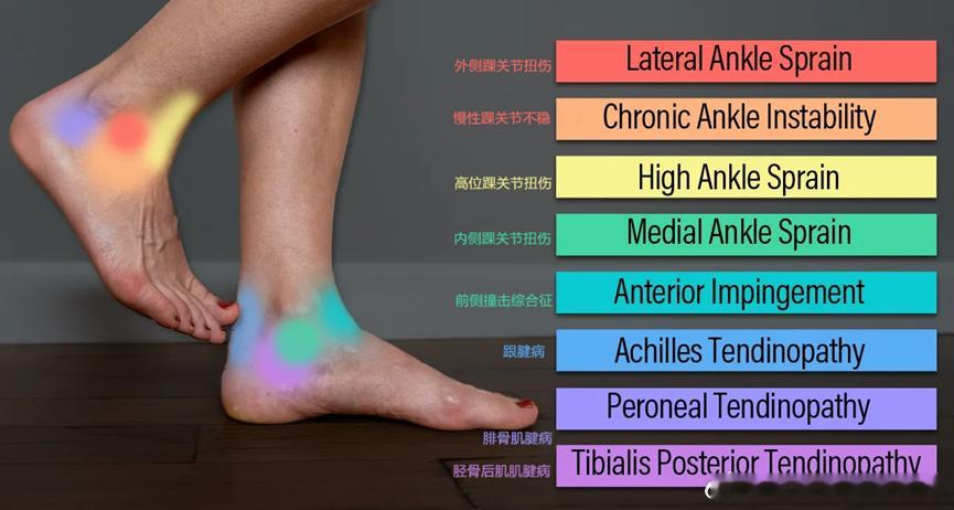 踝关节康复  看看这张脚踝损伤的图，里面疼得五颜六色的[笑cry]你们现在有什么