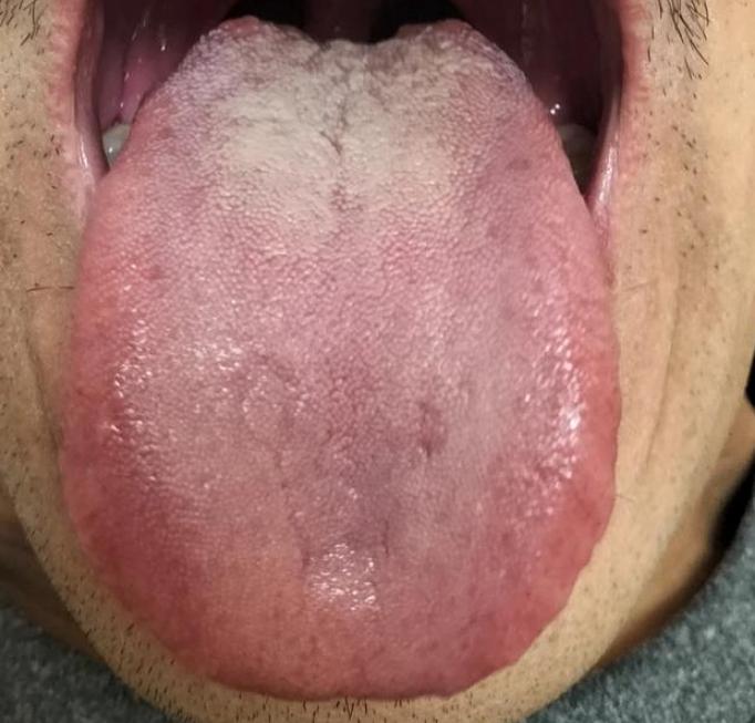 人菜瘾又大，说的就是这种舌象
 
患者说男科方面大大减退，晚上也经常失眠，脾气比