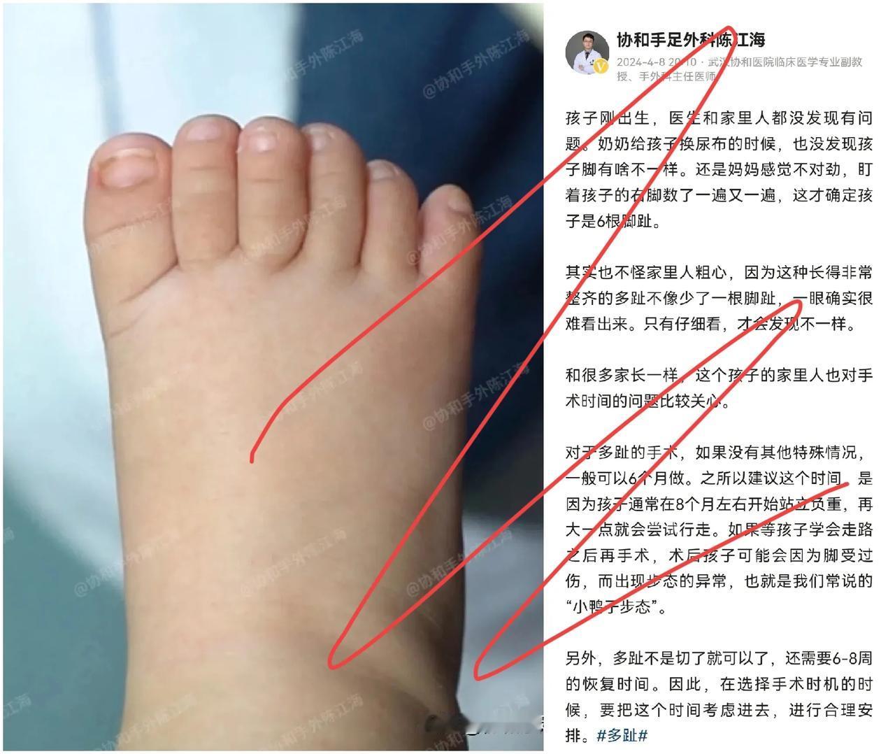 宝宝天生六趾，妈妈细心发现！专家建议6个月大手术，避免“小鸭子步态”




古