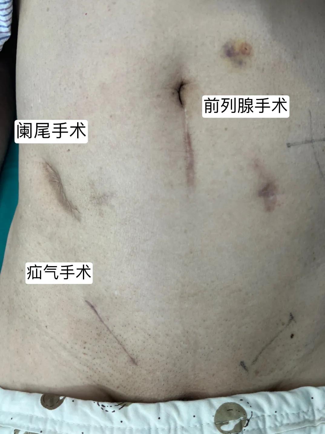 三次手术，三个疤痕，你觉得差别大吗？还是我们做的腹股沟疝气手术缝合的好一些吧