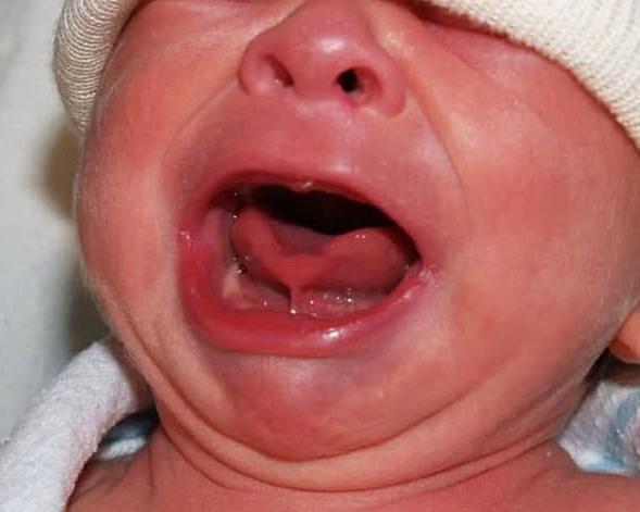 孩子舌系带太短真的需要剪一刀吗很多家长第一次听说“舌系带太短”，往往是在孩子出生