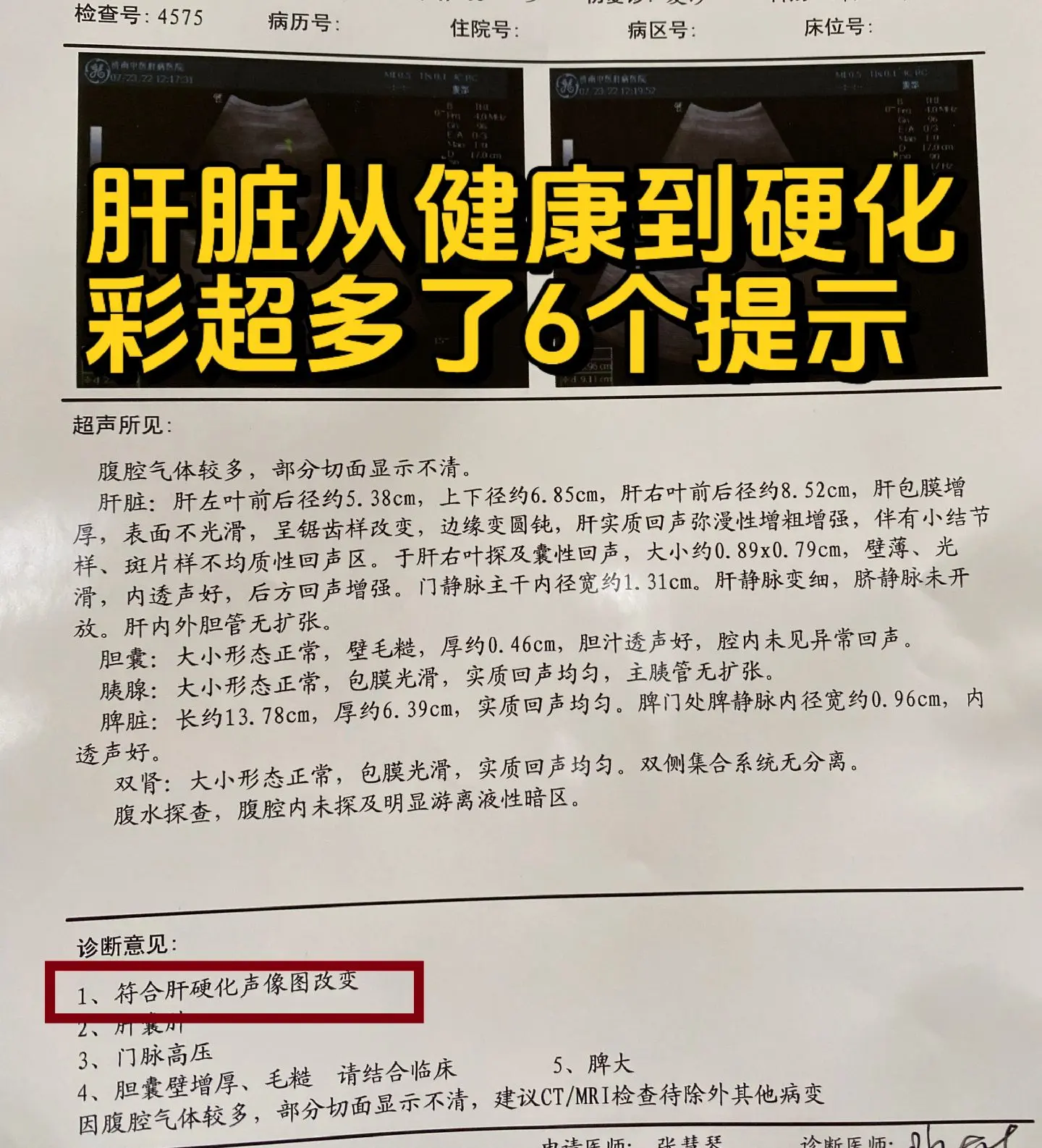 1.长度和体积改变，左右叶比例失调，边缘欠清晰变圆钝，呈锯齿状。 2....