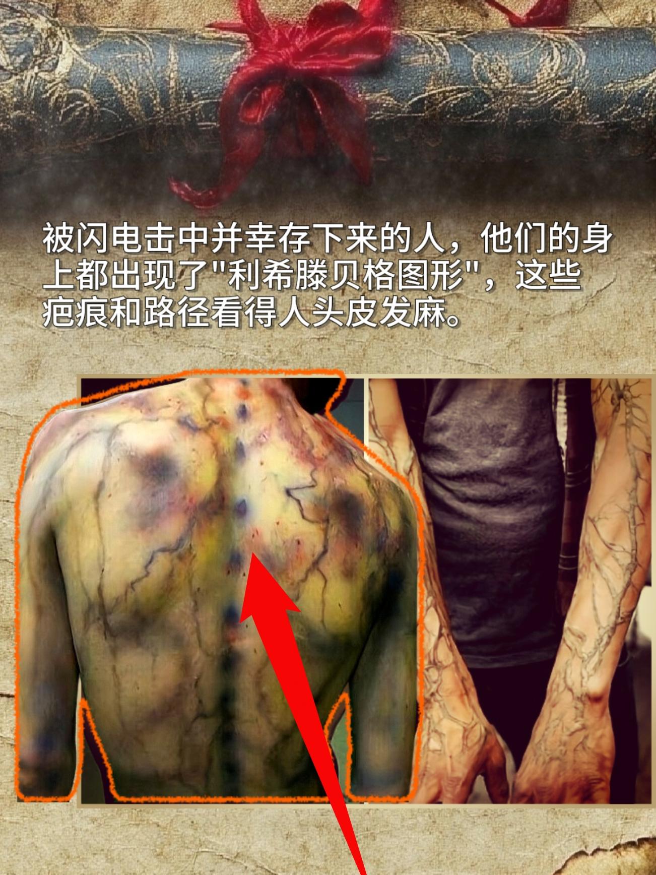 被闪电击中并幸存下来的人，他们的身上都出现了"利希滕贝格图形"，这些疤...