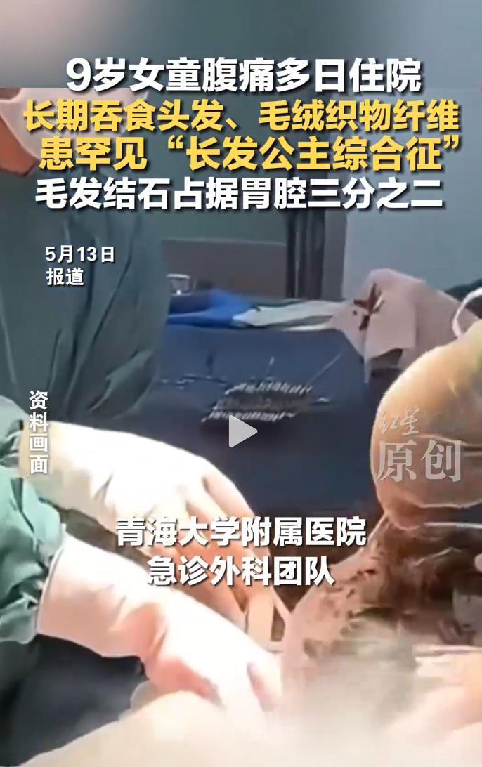 9岁女童因持续腹痛住院，胃腔三分之二被毛发结石，确诊“长发公主综合征”。
 
女