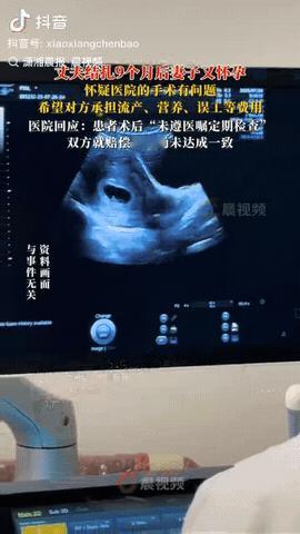近日，河北，一男子结扎9个月后，不料妻子竟然怀孕了，于是妻子怀疑医院的结扎手术没