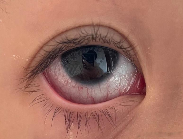 发烧、眼睛红，红是这样式儿的，要注意腺病毒感染的可能哦～#医笔医话##儿童常见病