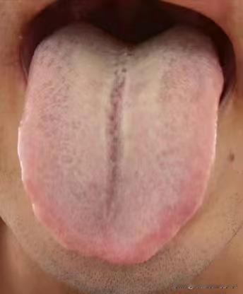 舌头裂纹长又深，再拖下去，华佗在世也难治！

患者主诉：脾气暴躁，难以控制，嘴巴