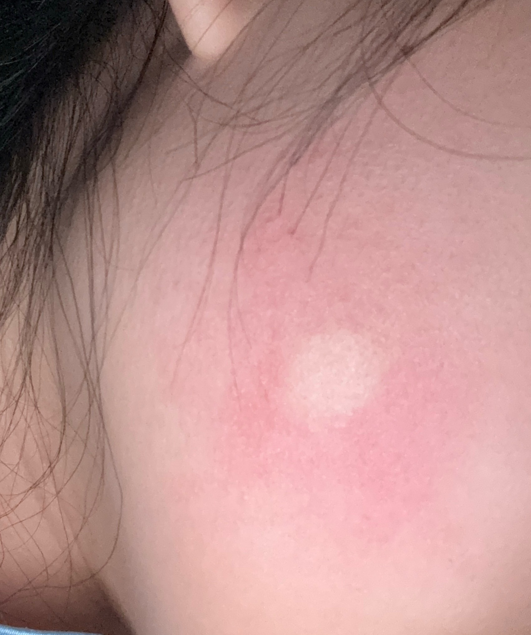 现在的蚊子咋这么毒