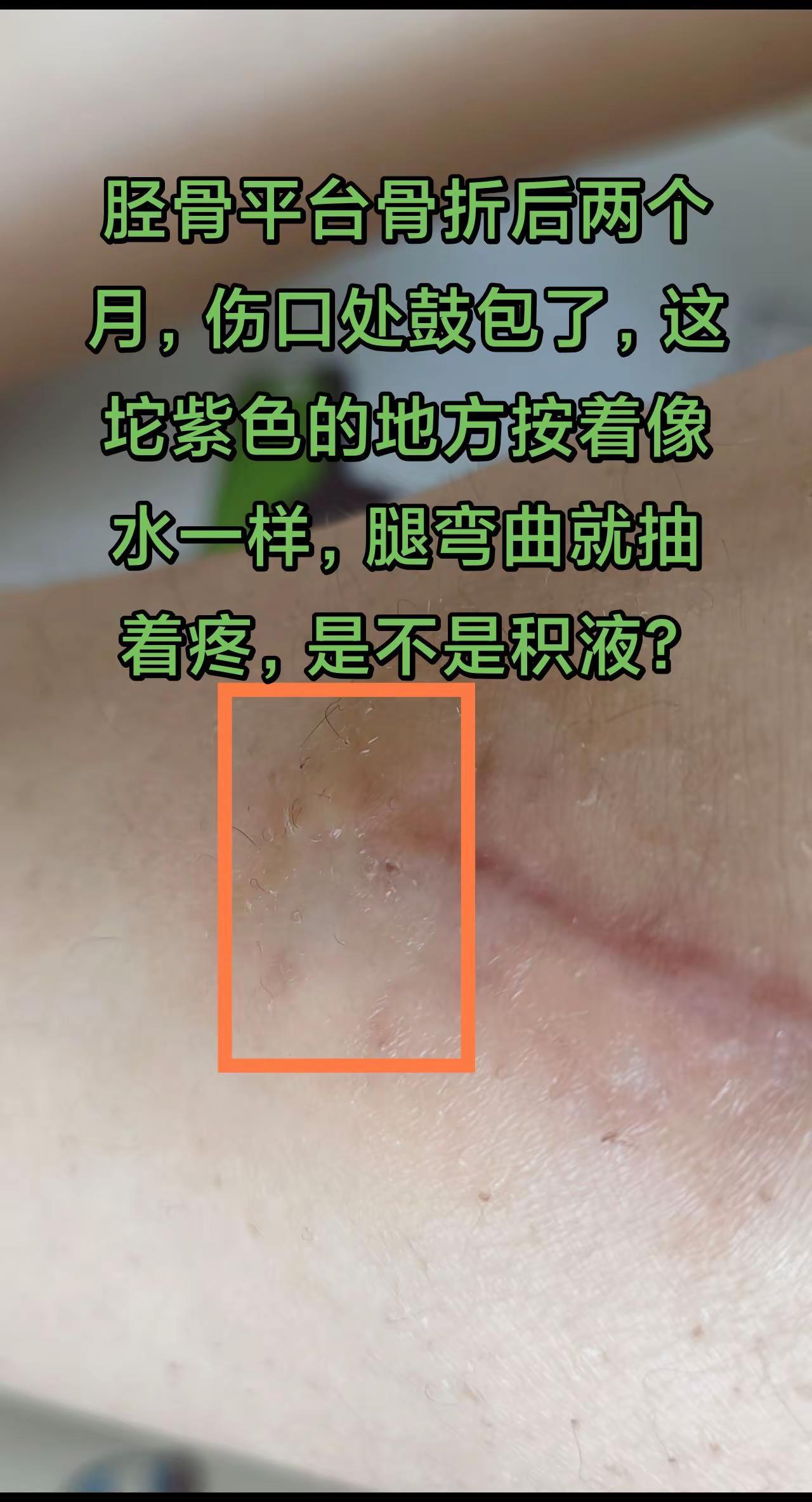 豆包说是积液，我一动就疼，但是感觉这么一点也不够去医院的程度，有没有折友有同样症