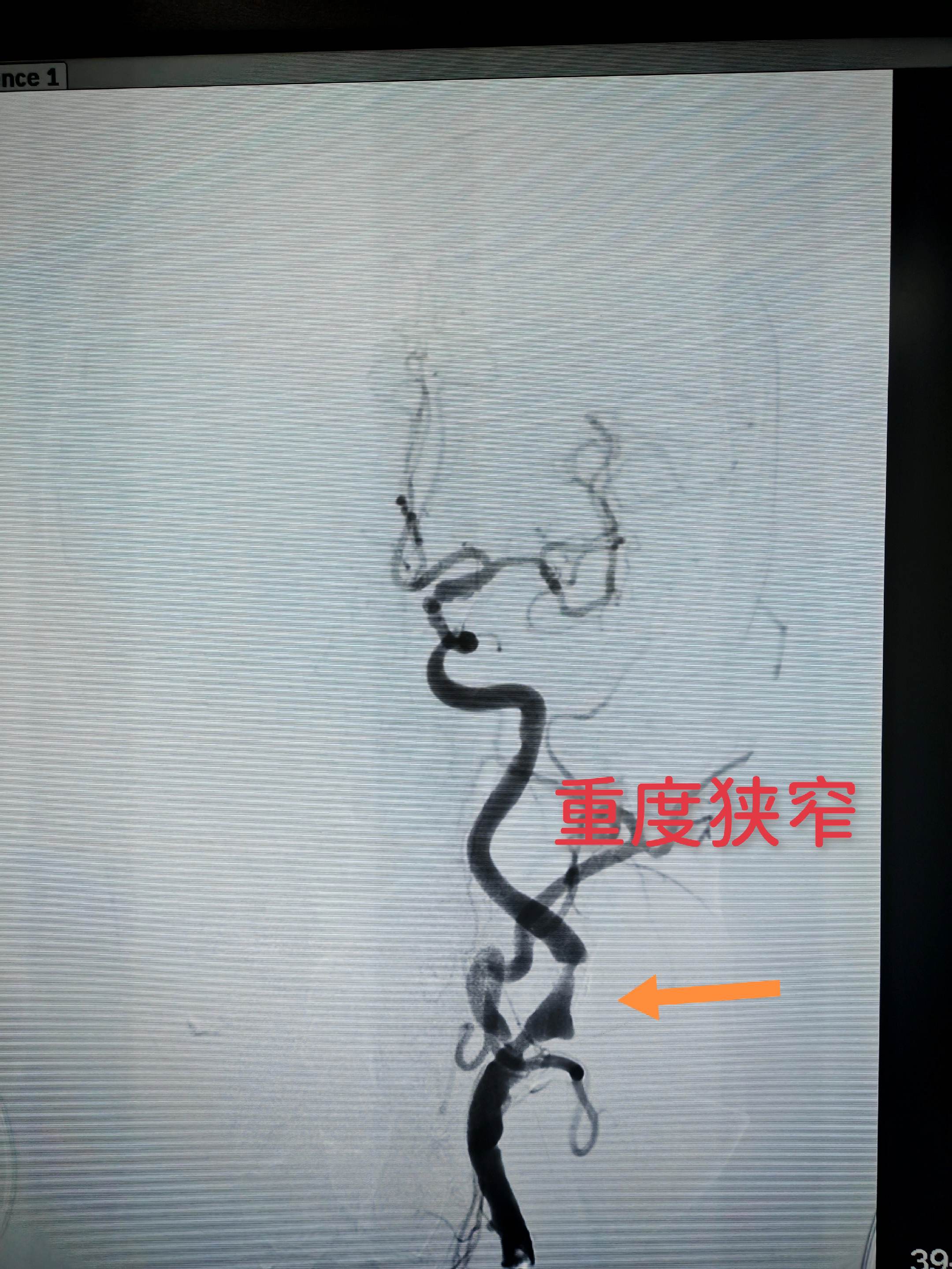 颈动脉重度狭窄，生命通道告急！今日，我们通过微创介入，成功为患者实施...