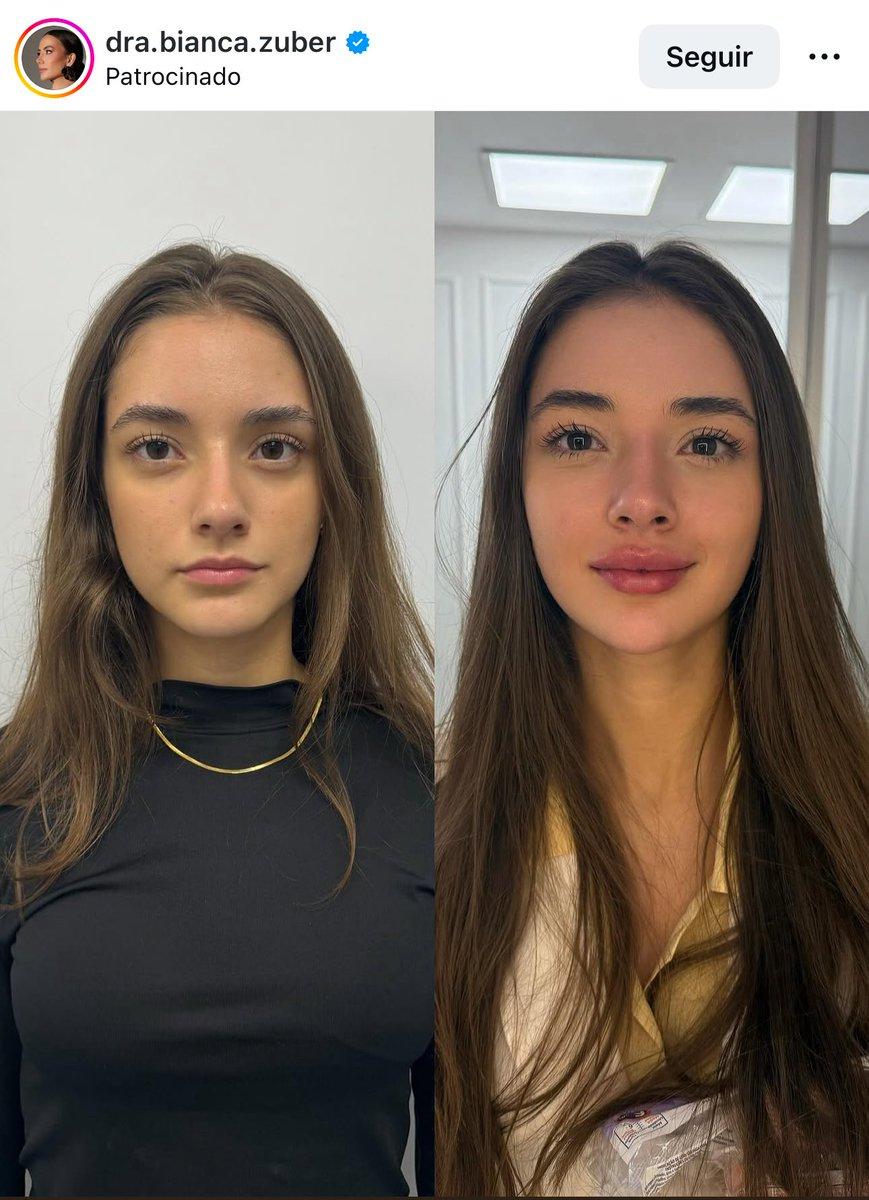 这个女孩做了嘴部整容手术，大家觉得怎么样？