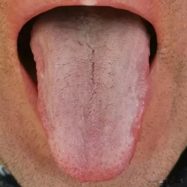 舌象分析：总失眠 内火旺 还有阴虚和湿热 宗筋疲软怎么办？
1、“舌尖红”——心